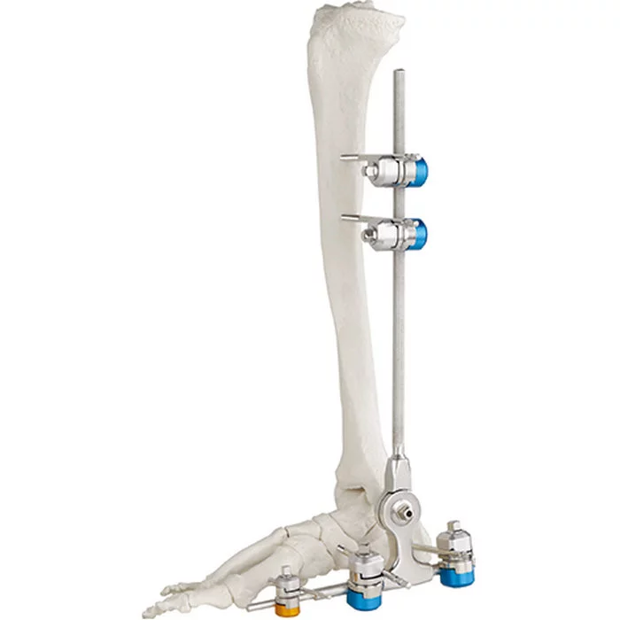 Knochen-Hammer-chirurgisches orthopädisches Instrument-Knöchel-Gelenk der hohen Qualität externes medizinische Instrument-Knochen-Instrument Fixator