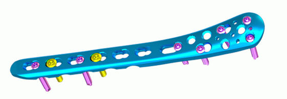 Distale Mittelschienbein-Titanplatten-proximales Schienbein-Sicherungsblech