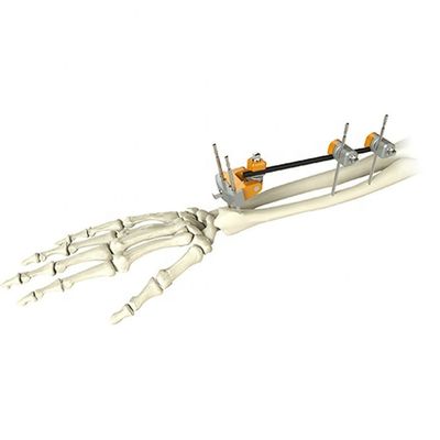 Medizinischer orthopädischer Ellen-distaler Radius-Bruch-externe Fixierung