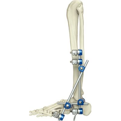 Medizinischer orthopädischer Instrument-Knöchel-externes Fixierungs-Gerät