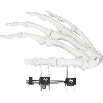 Orthopädisches chirurgisches Mini Fragment Ilizarov External Fixations-Gerät