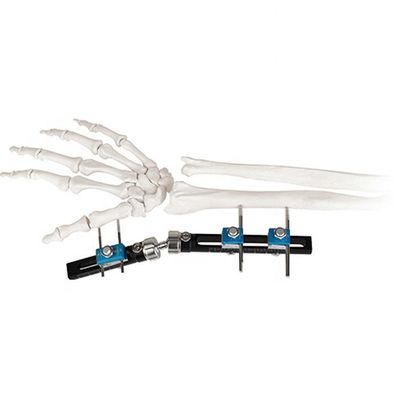 Orthopädisches chirurgisches externes Fixierungs-Gerät-Handgelenk