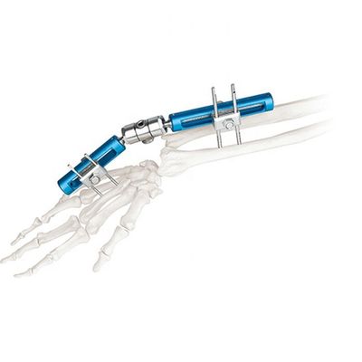 Orthopädisches chirurgisches externes Fixierungs-Gerät-Handgelenk