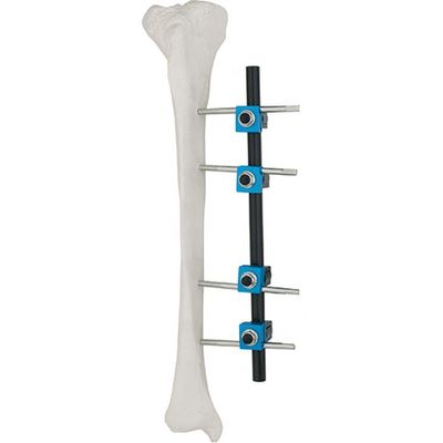 Qualität versicherte orthopädische chirurgische Instrumente Tibial externe externe Fixierungs-orthopädischem Implantat Fixator AO