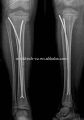 Orthopädisches Titan-elastischer Nagel der Implantats-ZEHN für Kinderchirurgie