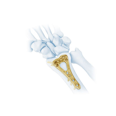Trauma-multi axiale Palmen-distale Radius-Bruch-Platte II