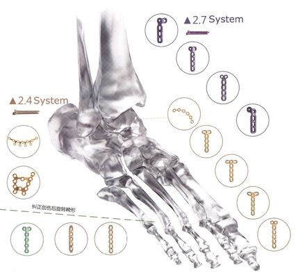 Orthopädisches Implantats-Knochen-Bruch-Titansicherungsblech für Handfuß